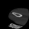 SPORK, NICO - 22.03.1976 - 02.08.2022 - CT obere Extremität - 17:51:17